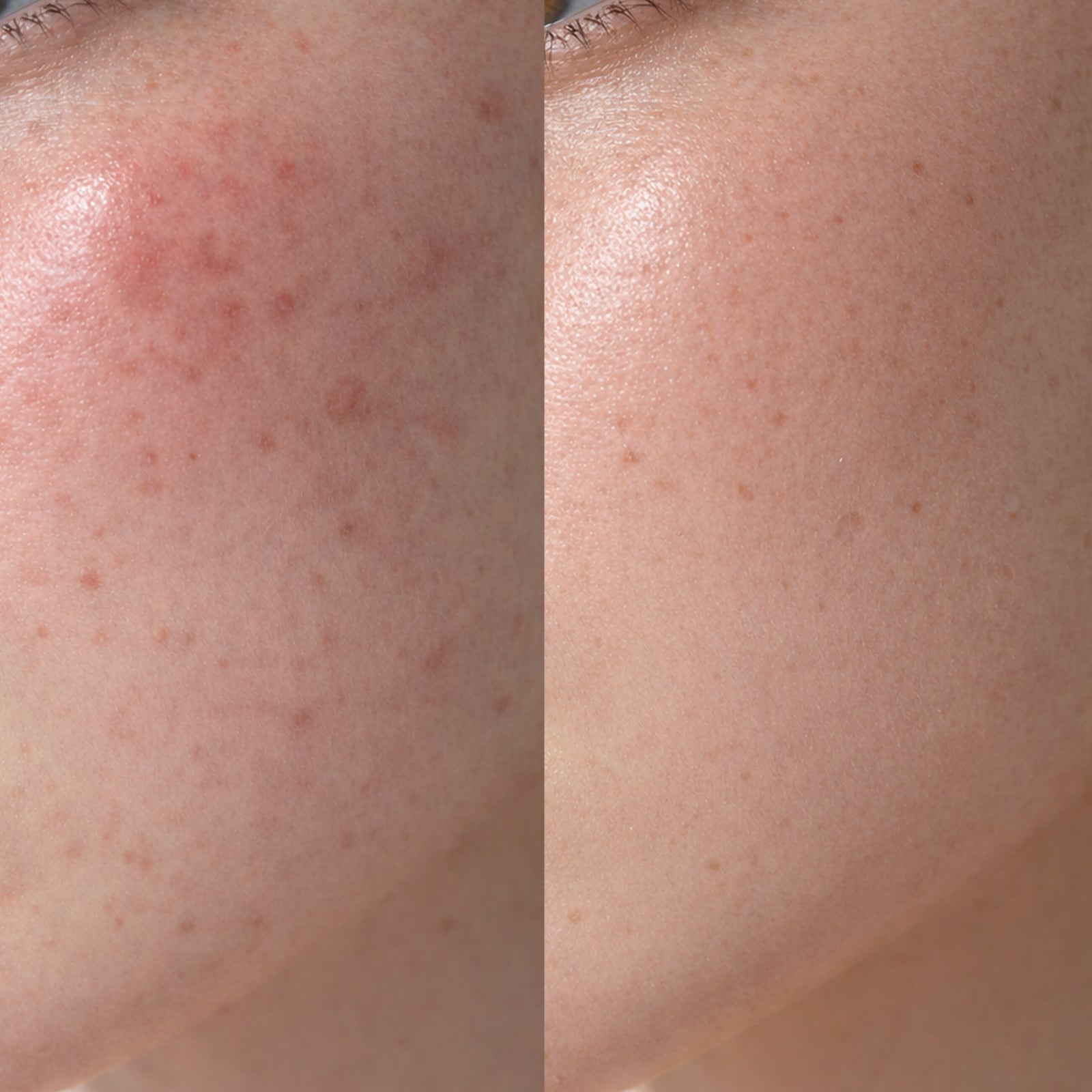 D Program Balance Acne Care Emulsion